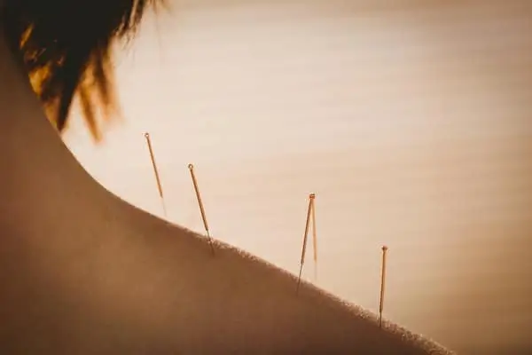 young-woman-getting-acupuncture-treatment