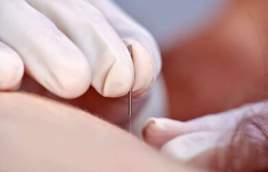 Best Dry Needling Therapy Edmonton | Family® Physio
